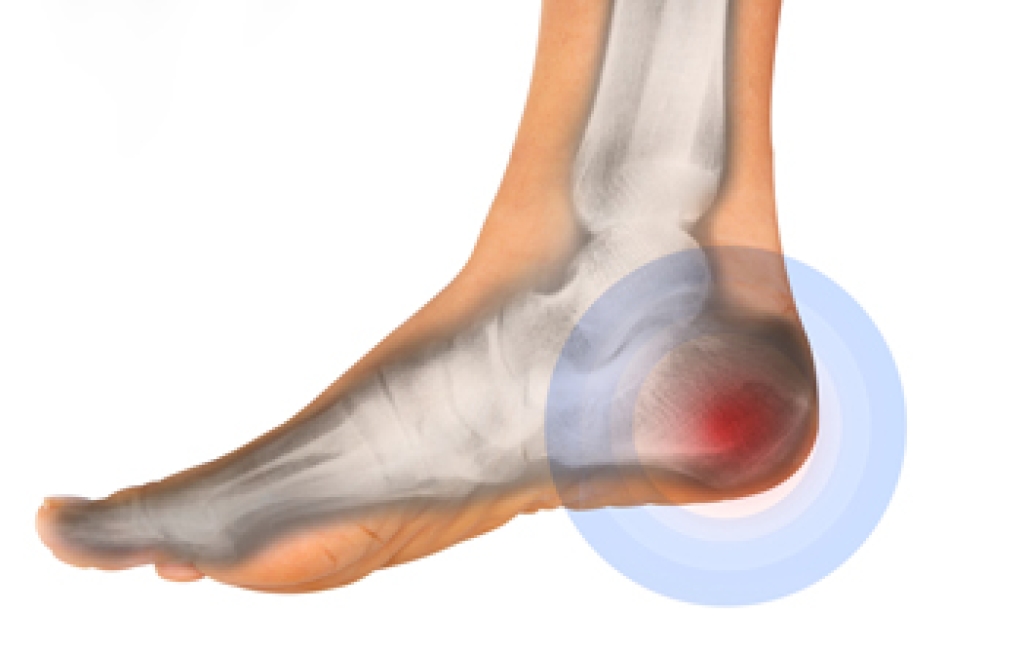 Heel Pain May Be Linked to Ankylosing Spondylitis