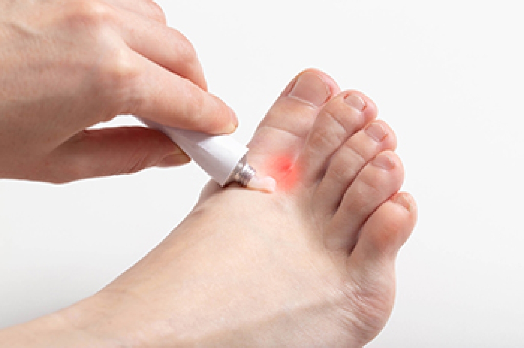 Blisters and Skin Irritation From Athlete’s Foot