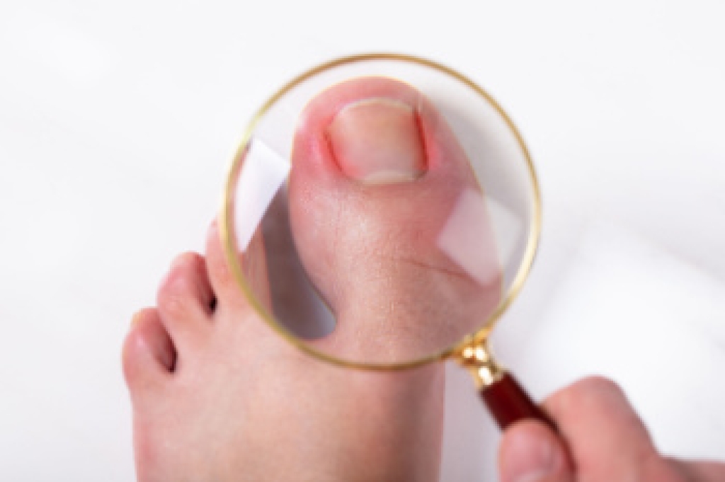When a Curled Toenail Grows Into the Skin