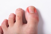 Preventing Painful Ingrown Toenails