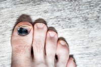 Causes of Black Toenails