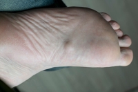 What Is Plantar Fibromatosis?