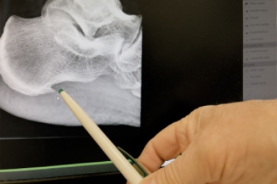 Symptoms and Causes of Heel Spurs