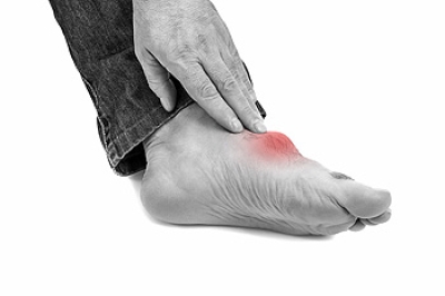 Definition and Causes of Gout