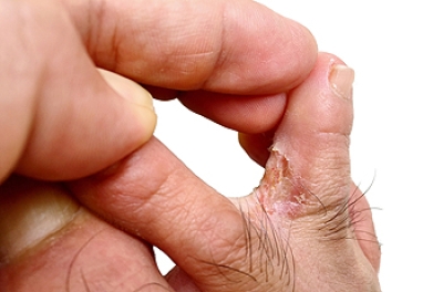 A Podiatrist’s Role in Treating Athlete’s Foot