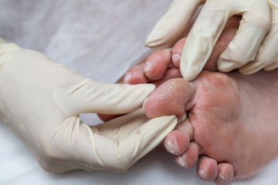 Protecting Your Feet When You Have Diabetes