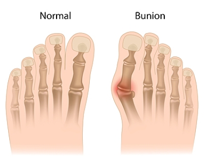 Why Women Are More Prone to Bunions
