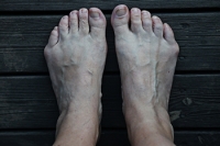 Bunionette Treatment